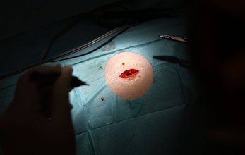 spotlight on a blue antiseptic cloth with a hole that shows a bleeding incision